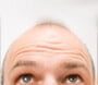 cure__alopecia